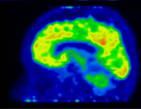 Tyypilliset PIB+ kertymäalueet Nucleus caudatus Frontaalikorteksi