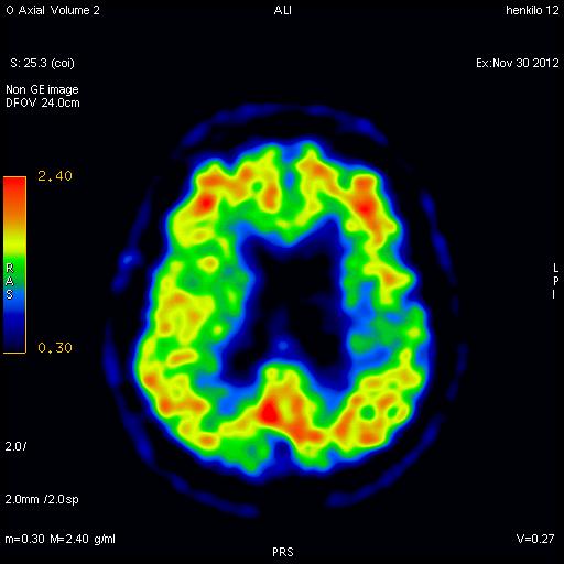 FDG PET 10/12: FTD:n ja AD:n piirteitä, enemmän FTD.