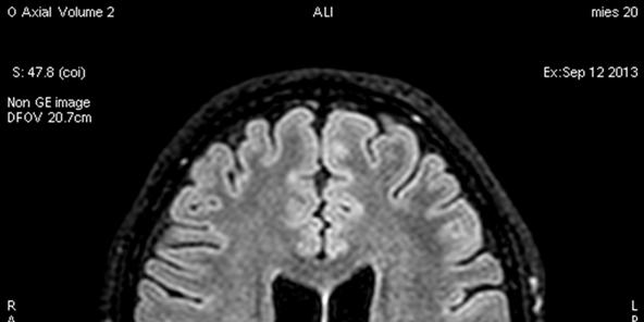 Epileptinen fokus ja dysplasia