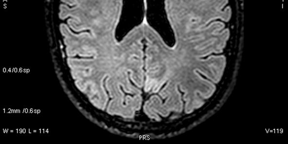 dysplasia alueella on