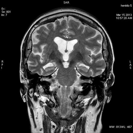 Tyypillinen Alzheimerin taudin FDG löydös