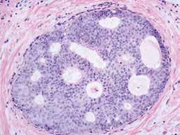 D) Lobulaarinen in situ karsinooma (LCIS) rinnassa. Monotoninen pienikokoinen solukko täyttää laajentuneiden lobulusten luumenit. Mukailtu viitteestä (14).