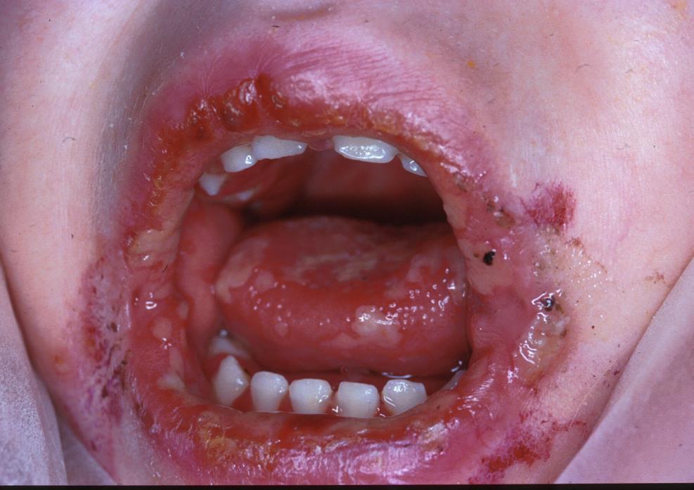 Muut suuinfektiot Primaari herpes simplex virus stomatiitti Voi vaatia sairaalahoitoa, jos