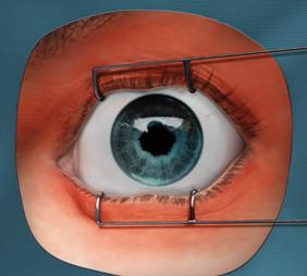 Intravitreal guidelines and techniques ONE Network. The ophthalmic news and education network. American Academy of Ophthalmology. http://one.aao.org/focalpointssnippetdetail.aspx?