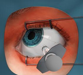 The Royal College of Ophthalmologists Luettavissa osoitteessa: https://www.rcophth.ac.uk/wp-content/uploads/2015/01/2009-sci-012_ Guidelines_for_Intravitreal_Injections_Procedure_1.pdf.