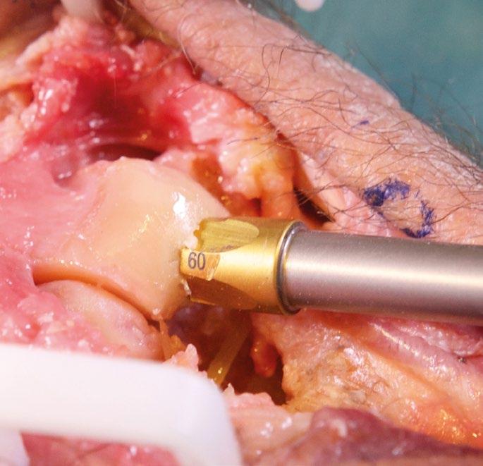 Poraussyvyys voidaan nähdä suoraan Cannulated Metacarpal Drill -poranterän leikkausurista.