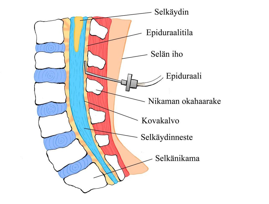 5 olla kontaktissa luiseen spinaalikanavaan rajoittaen epiduraalitilan erillisiin osiin.