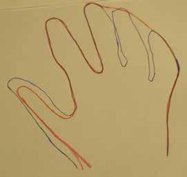 5-4 CRPS I fysioterapia ja toimintaterapia Mittanauhalla mitataan yksittäisten sormien turvotusta ja myös mittauskohta kirjataan ylös helpottamaan myöhempiä mittauksia.