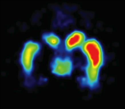 MRI-GUIDED INFUSION 1 2 3 4 POST - MORTEM TISSUE ANALYSIS BASELINE Six weeks post MPTP 0