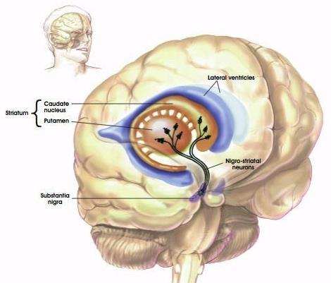 CDNF-proteiiniterapia Parkinsonin tautiin Terapeuttinen proteiini ei läpäise aivoveriestettä, joten se vaatii erityisen annostelutekniikan suonensisäinen annostelu ei toimi Parkinsonin taudissa