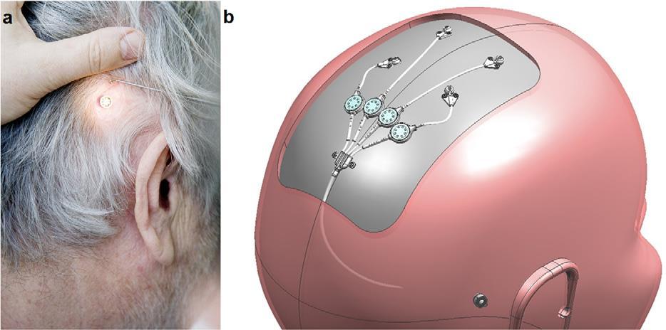 katetrin avulla Varmistetaan, että lääkeproteiini päätyy sinne minne pitää Kirurginen operaatio käytännössä sama kuin DBS-operaatio (Deep Brain Stimulation) Myöhemmässä kehitysvaiheessa pyritään