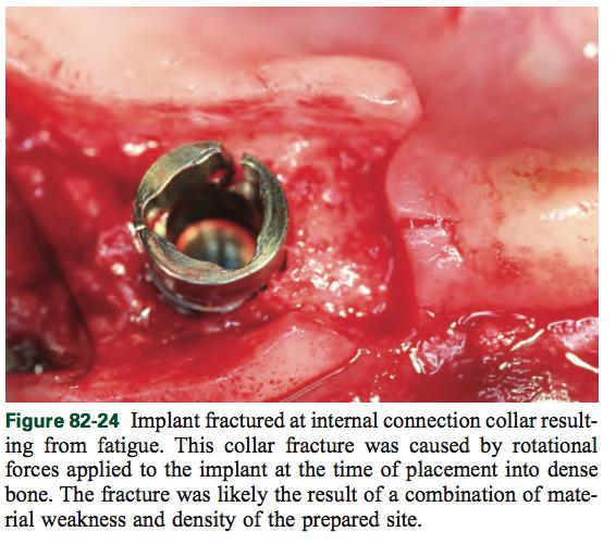 Implanttikirurgia on suoritettava steriilisti ja atraumaattisesti. Implantointi suoritetaan osteotomiaporilla, joita käytetään hitaalla kierrosnopeudella, mutta suurella vääntömomentilla.