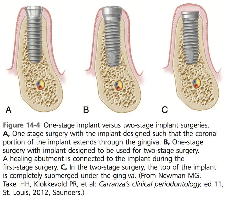 3.3 Implantoinnin onnistuminen Implantin ja luukudoksen välinen osseointegraatio kehittyy implantin paranemisvaiheen aikana, jolloin luukudos asettuu vaiheittain välittömään kontaktiin implantin