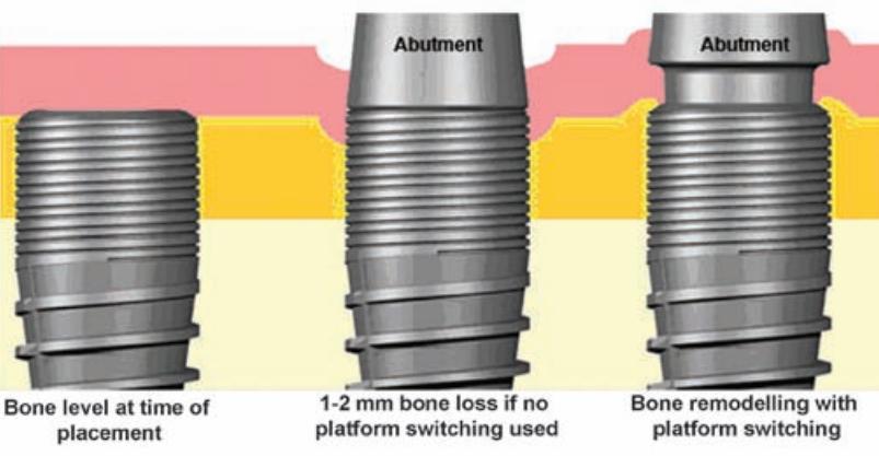 Implanttijatkeella on vaikutusta implantin koronaaliosaa ympäröivään luukudokseen sekä täten myös implantin ja luukudoksen väliseen osseointegraatioon.