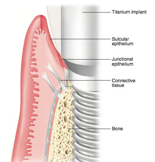 suuontelon ja implantin välillä. Peri-implanttikudos, tai peri-implanttimukoosa, muistuttaa parodontaalikudoksia ja niillä on yhteisiä tekijöitä.