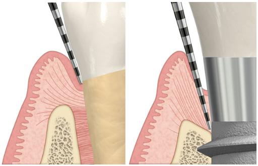Peri-implanttimukoosa on keskimäärin 3 4 millimetrin pehmytkudosvyöhyke, joka ollessaan terve suojaa implantin osseointegraatioaluetta suun alueen mikrobistolta ja muilta patogeenisiltä tekijöiltä.
