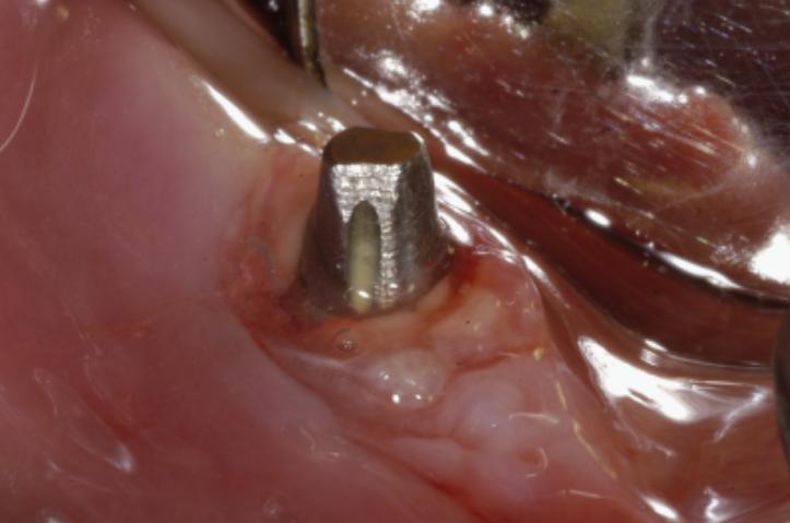 Kuva 10. Peri-implantiittinen implantti. (20) Peri-implantiitin esiintyvyys vaihtelee tutkimuksittain.