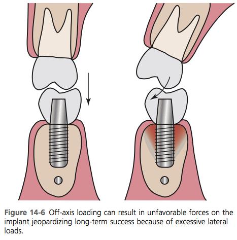 (2) Implantin ylikuormitus ei itsessään aiheuta marginaalista luukatoa, mutta se toimii luukudoksen resorptiota voimistavana tekijänä.