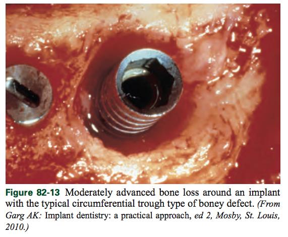 5.3 Peri-implantiitin hoito CIST protokollan tilanteessa D (peri-implantiitti) implantti dekontaminoidaan kirurgisessa avauksessa, kun infektio ensin on mahdollisuuksien mukaan saatu hallintaan