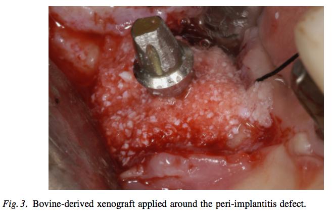 Kuva 22. Peri-implanttisen implantin defektialue on puhdistettu ja implantin pinta on dekontaminoitu. Leesioalue on täytetty keinoluumateriaalilla.