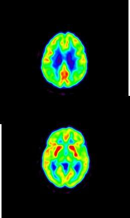 Hypometabolismi MIRAS:ssa PET: