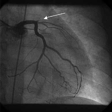 TAPAUSSELOSTUS 1974 nämäkytkentöihin (kuva 1 B). Sydämen ja keuhkojen auskultaatiolöydös oli normaali. Veren troponiini I:n (TnI) pitoisuus oli päivystyspoliklinikassa 0,74 µg/l.