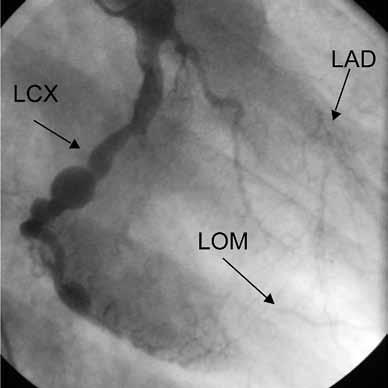 KUVA 4. Potilaan 2 elvytyksen jälkeinen EKG, jossa näkyy ST-välin massiivinen lateraalinen nousu. aneurysmaattisia laajentumia, ahtautumia ja täydellisiä tukoksia (kuva 5 A ja B).