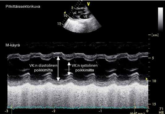 TAPAUSSELOSTUS KUVA 6. Rintalastan vasemmasta reunasta rekisteröity sydämen pitkittäissektorikuva ja M-käyrä, jossa nähdään lähes normaali vasemman kammion supistuminen (ejektiofraktio 50 %).