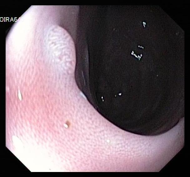Severe chronic eosinophilic gastritis in antrum Mild