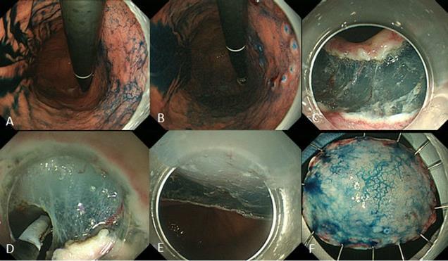 (EMR) Endoscopic submucosal dissection (ESD)