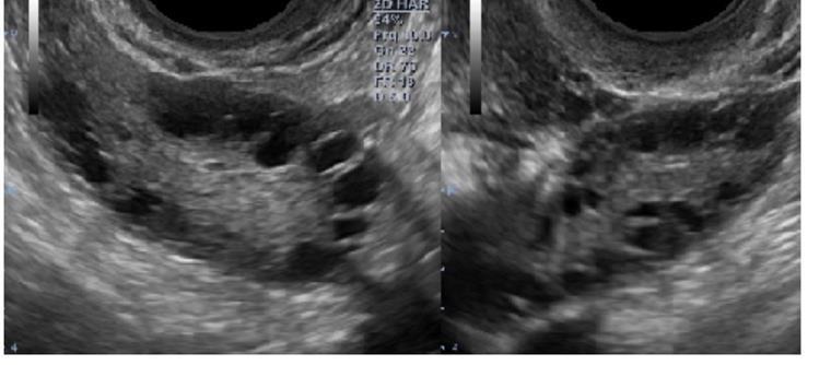 Emättimen kautta tehtävällä kaikututkimuksella vahvistetaan PCOS diagnoosi sekä siinä nähdään ovarioissa monirakkulainen munasarjarakenne.