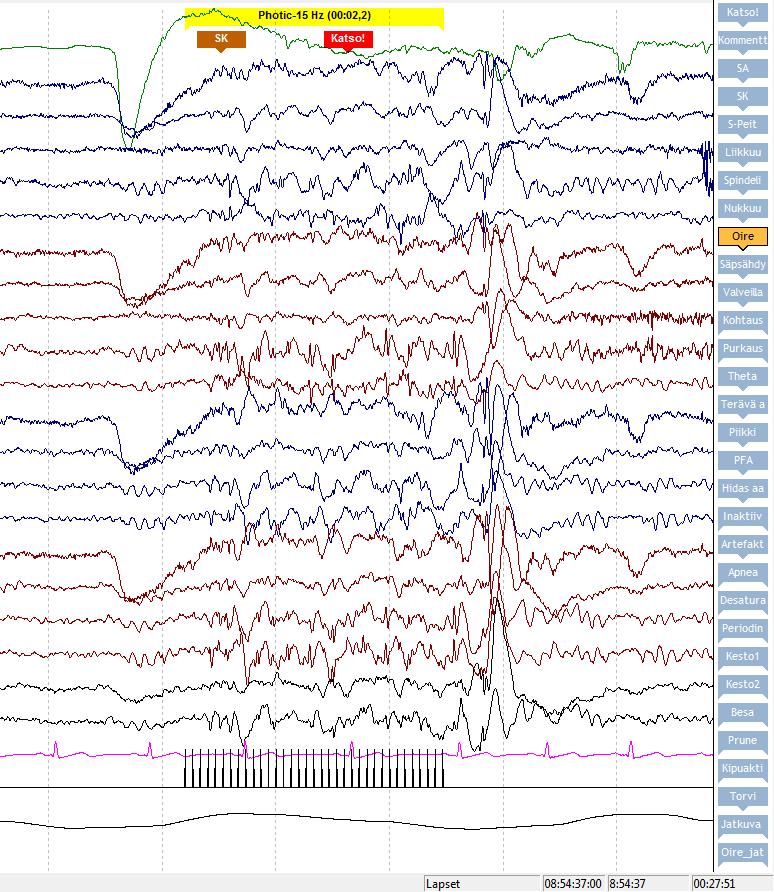 Poikkeava purkaus vilkkuvalossa Leviävä (takaosista eteen) tai yleistynyt purkaus 70-77%:lla on epilepsia KNF-oppikirja = fotokonvulsiivinen vaste Paikallinen, okkipitaalisia piikkejä