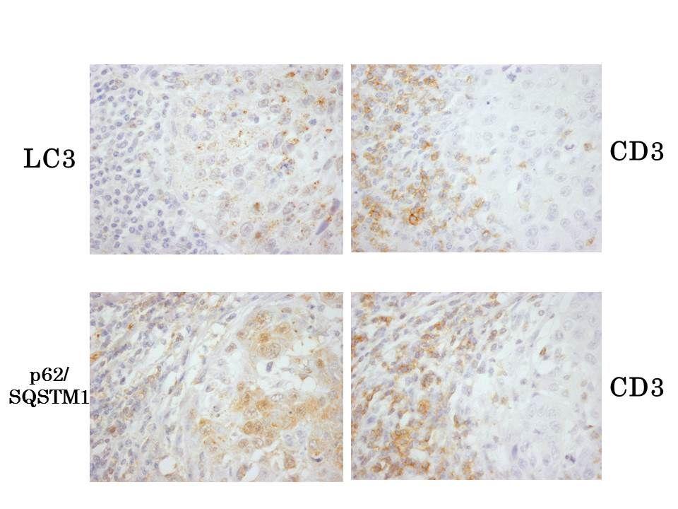 CD3+T CD56 (2)2: in vivo natural killer (NK) (FFPE)Beclin1 LC3 autophagy HLA class I/II APM 74 LC3 27 (36.5%) FFPE APM Beclin-1 27 (36.5%)p62/SQSTM1 24 (32.