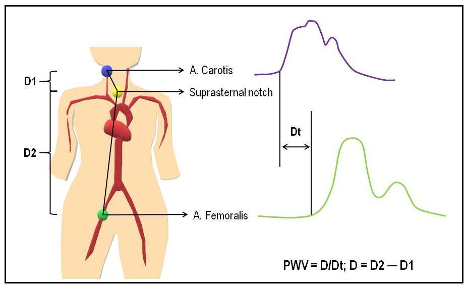 site to sternal notch distance from the sternal notch to the femoral measurement site distance. PWV was calculated as D/Dt (m/s) (Agabiti-Rosei et al. 2007, Laurent et al. 2006).