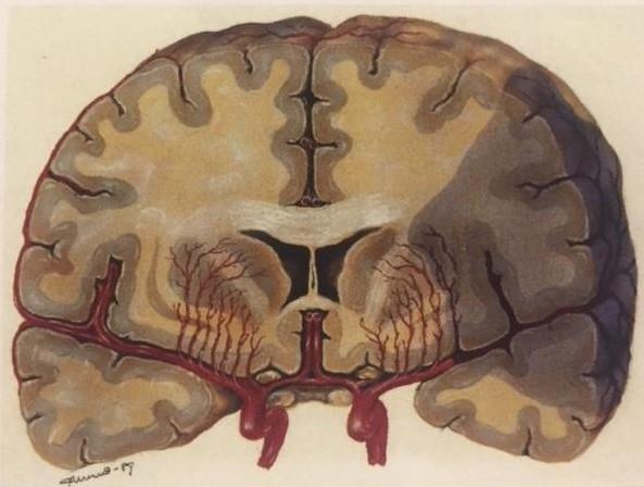 10 Tummempi alue aivoissa on aivokudosta, joka on mennyt kuolioon puutteellisen verenvirtauksen vuoksi. KUVA 1.