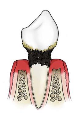 Suurin osa suun sairauksista johtuu plakista eli bakteerimassasta, joka kovettuu syljen vaikutuksesta hammaskiveksi: Suun terveyden vaikutus yleisterveyteen; suun kautta bakteereilla yhteys kehon eri