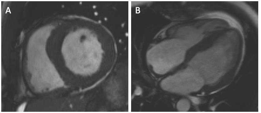 Review of the literature myocardium (1.05 g/mm 3 ). Volumes are typically indexed to body surface area (BSA), age and gender.