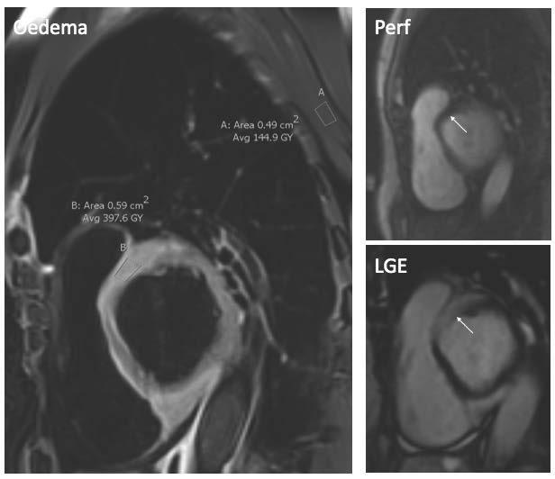 Figure 4. Left panel: T2-weighted short-axis image visualizing left ventricular myocardial oedema in a patient with giant cell myocarditis.