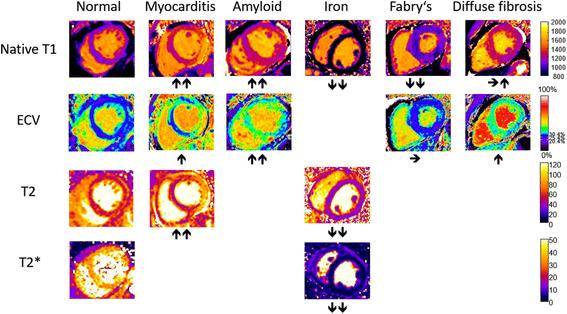 Figure 8. Parametric mapping of normal myocardium and patients with myocardial disease.