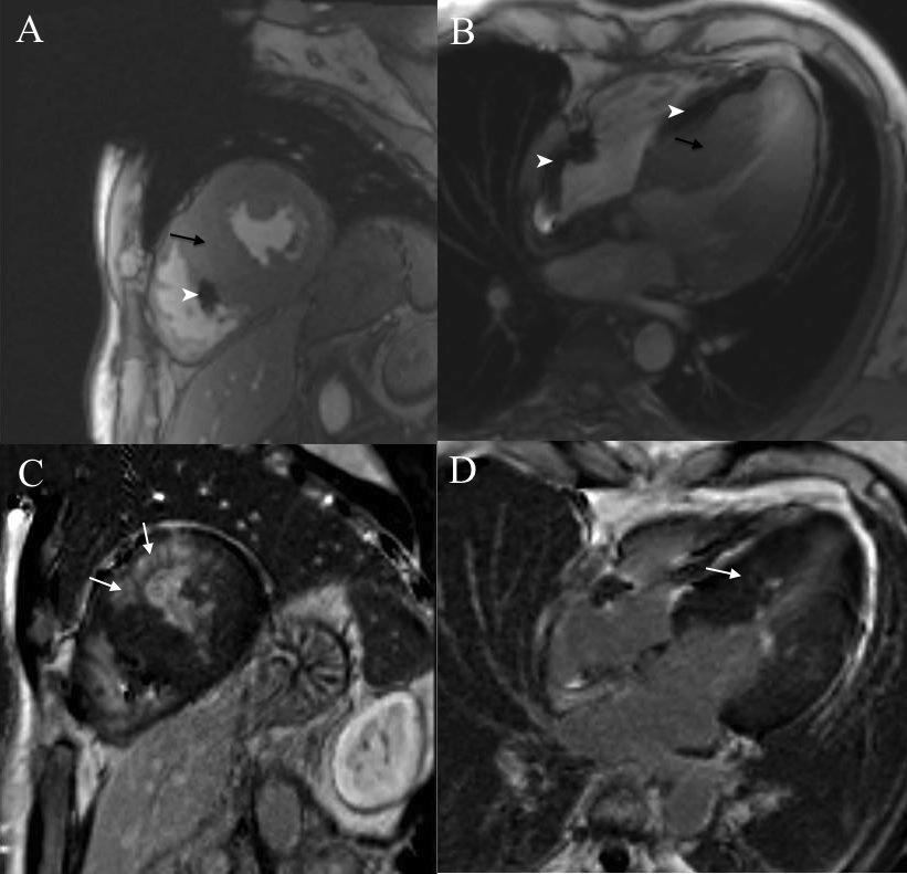 Figure 12. A 48-year-old male patient with PRKAG2 cardiomyopathy and a pacemaker. In short-axis and four chamber cine images septum is severely hypertrophied (A-B) (black arrows).