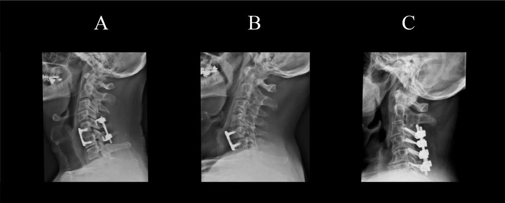Figure 2. Anterior and posterior fixation of C5-C6 (A), anterior fixation of C5-C6 (B), and posterior fixation of C3-C6 (C).