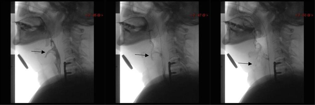 Figure 5. A series of VFSS images showing penetration. Material enters the airway, remains above the vocal folds, and is not ejected from the airway (PAS 3).
