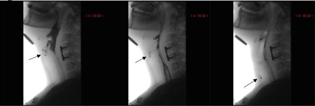 Figure 6. A series of VFSS images showing aspiration. Material enters the airway, passes below the vocal folds, and no effort is made to eject (PAS 8).  44