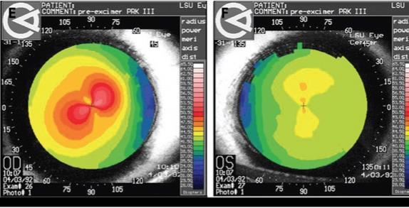 Keratoconus - Esiintyvyys 1/2000 Teini-ikä 40 v