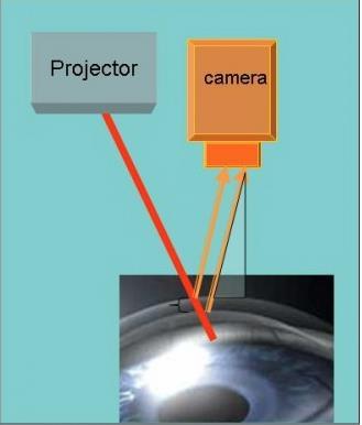 Tomografia Slit scanning