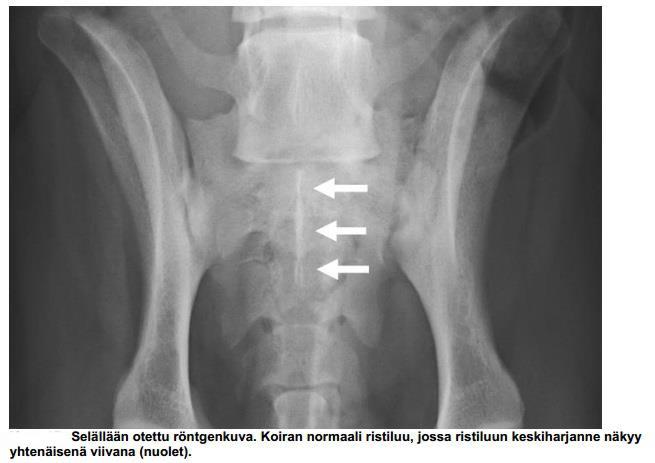 Välimuotoiset lanne-ristinikamat (LTV, lumbosacral transitional vertebra) Välimuotoisella nikamalla tarkoitetaan nikamaa, jolla on kahden eri nikaman piirteitä.