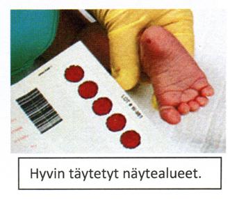 6 / 4.4.2019 3/5 4 Näytteenotto Lapsen kantapäätä lämmitetään verenkierron lisäämiseksi (ks. ihopistonäytteenotto). Puhdista kantapää 80 %:lla alkoholilla ja anna ihon kuivua.