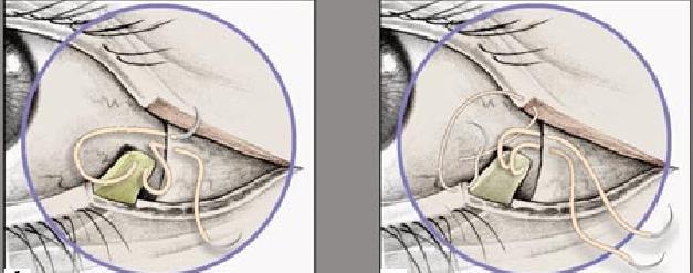 Lateral tarsal