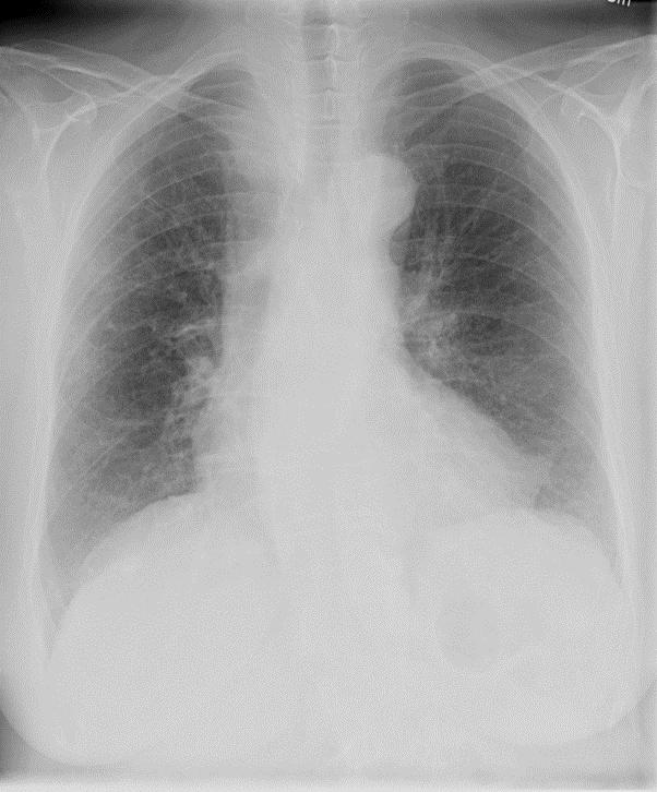 NSIP:n radiologisia löydöksiä Thoraxkuvassa bilateraalinen