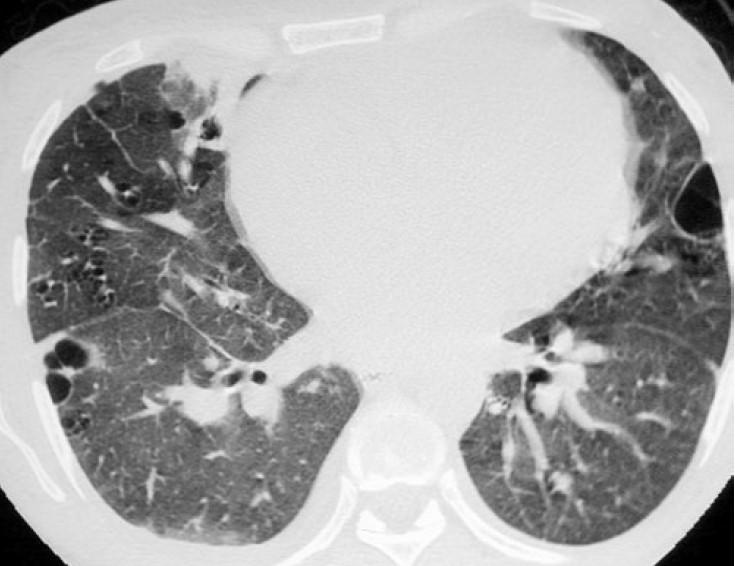 Radiologiset löydökset LIP Mattalasivarjostumat